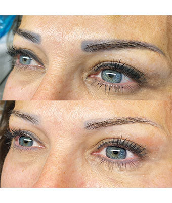 REVERSE -Remover PMU/Tattoo