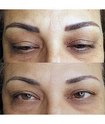 REVERSE -Remover PMU/Tattoo